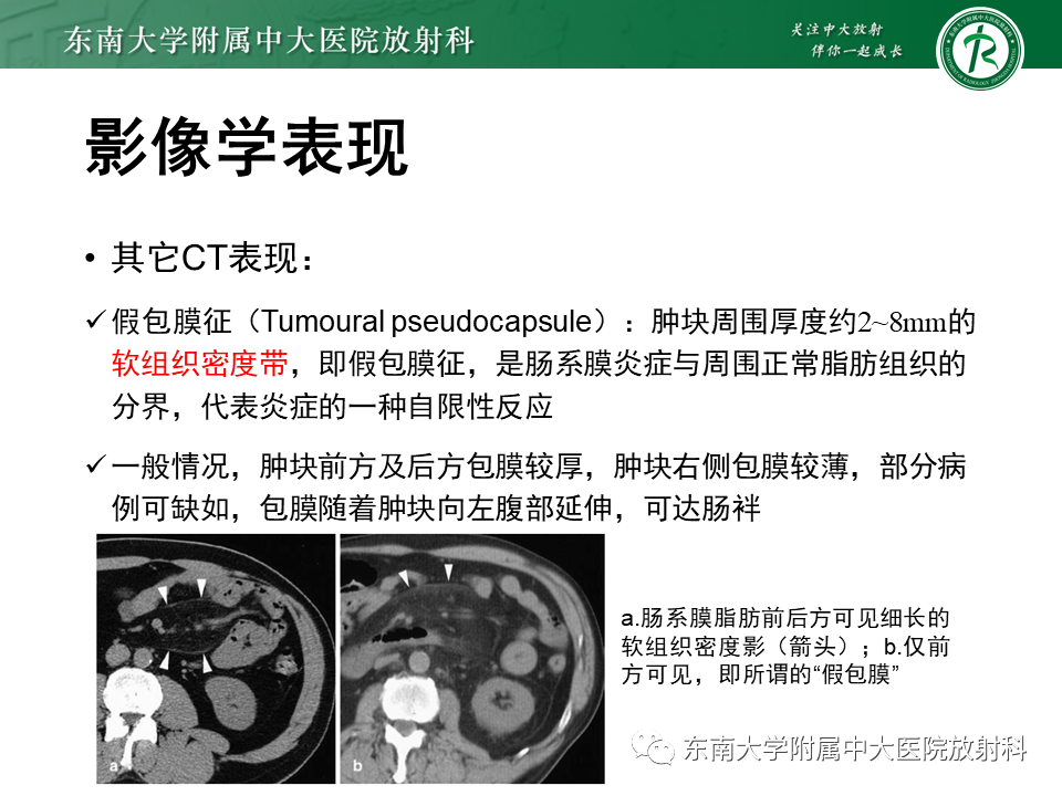 影像PPT - 【PPT】肠系膜脂膜炎-12