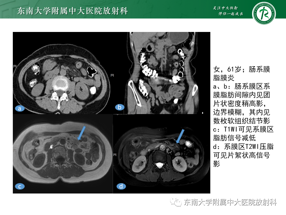 影像PPT - 【PPT】肠系膜脂膜炎-14