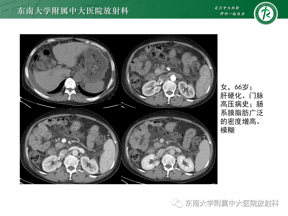 影像PPT - 【PPT】肠系膜脂膜炎-17
