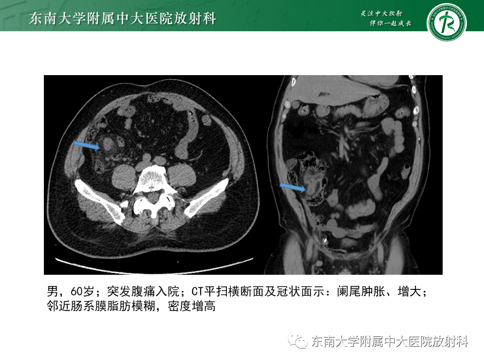 影像PPT - 【PPT】肠系膜脂膜炎-19