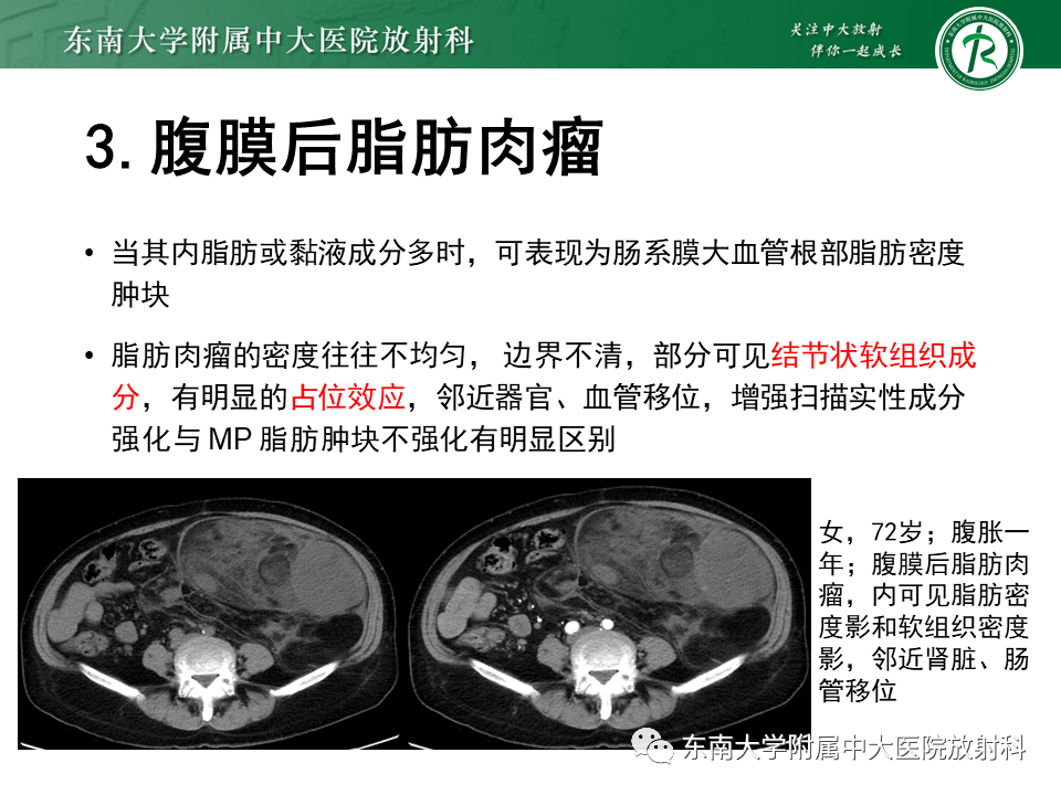 影像PPT - 【PPT】肠系膜脂膜炎-20