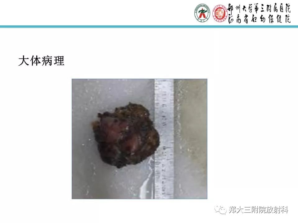 影像PPT - 【PPT】骶尾部脊索瘤的影像诊断-6
