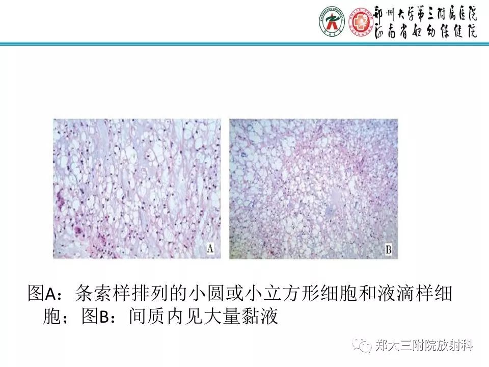 影像PPT - 【PPT】骶尾部脊索瘤的影像诊断-8
