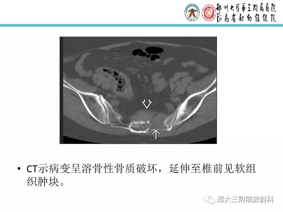影像PPT - 【PPT】骶尾部脊索瘤的影像诊断-13