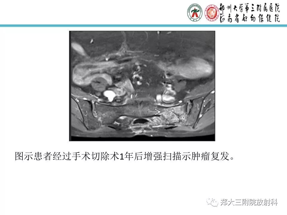 影像PPT - 【PPT】骶尾部脊索瘤的影像诊断-15