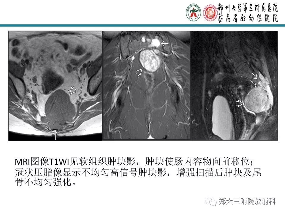 影像PPT - 【PPT】骶尾部脊索瘤的影像诊断-14