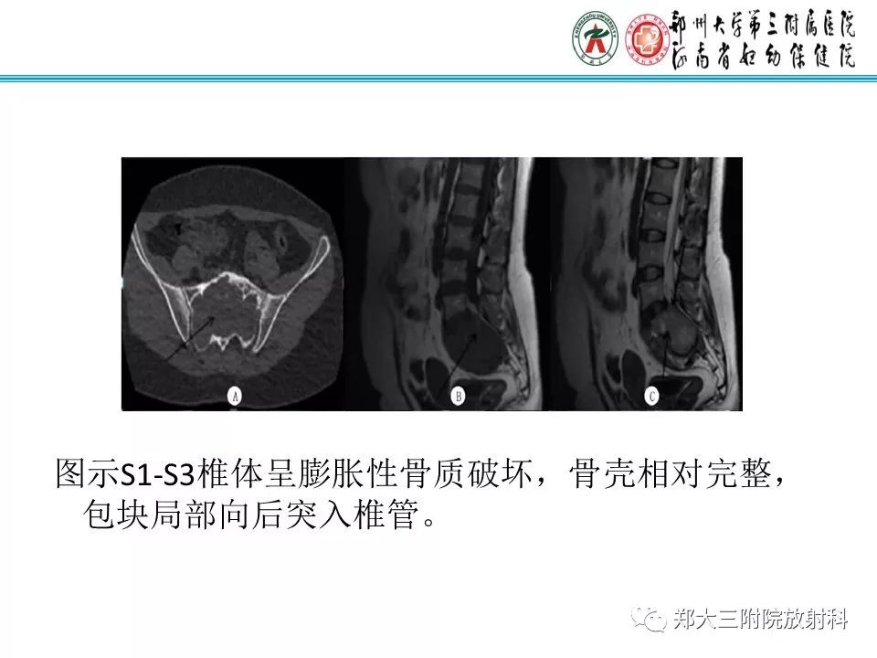 影像PPT - 【PPT】骶尾部脊索瘤的影像诊断-18