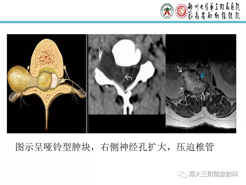 影像PPT - 【PPT】骶尾部脊索瘤的影像诊断-20