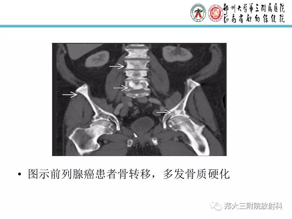 影像PPT - 【PPT】骶尾部脊索瘤的影像诊断-24
