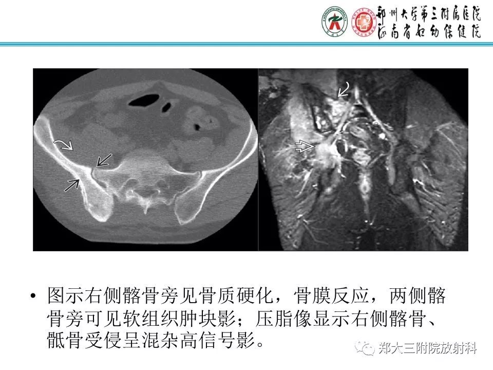 影像PPT - 【PPT】骶尾部脊索瘤的影像诊断-22