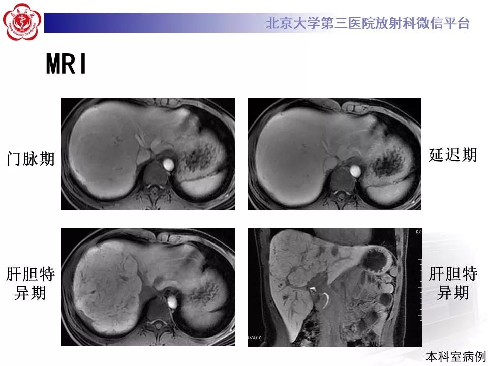 影像PPT - 【PPT】肝胆特异性对比剂的临床应用—肝局灶性病变-17
