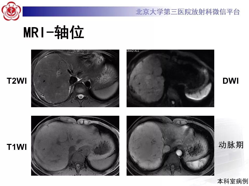 影像PPT - 【PPT】肝胆特异性对比剂的临床应用—肝局灶性病变-16