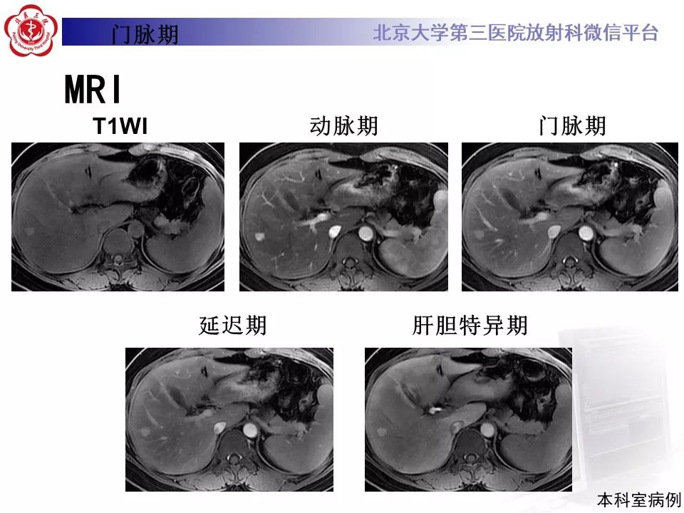 影像PPT - 【PPT】肝胆特异性对比剂的临床应用—肝局灶性病变-22