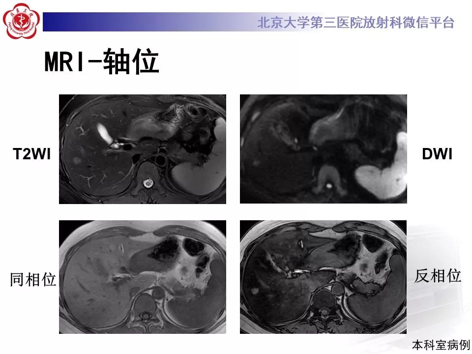 影像PPT - 【PPT】肝胆特异性对比剂的临床应用—肝局灶性病变-21