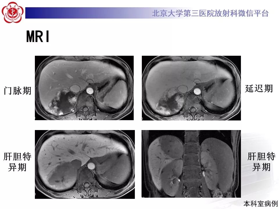影像PPT - 【PPT】肝胆特异性对比剂的临床应用—肝局灶性病变-30