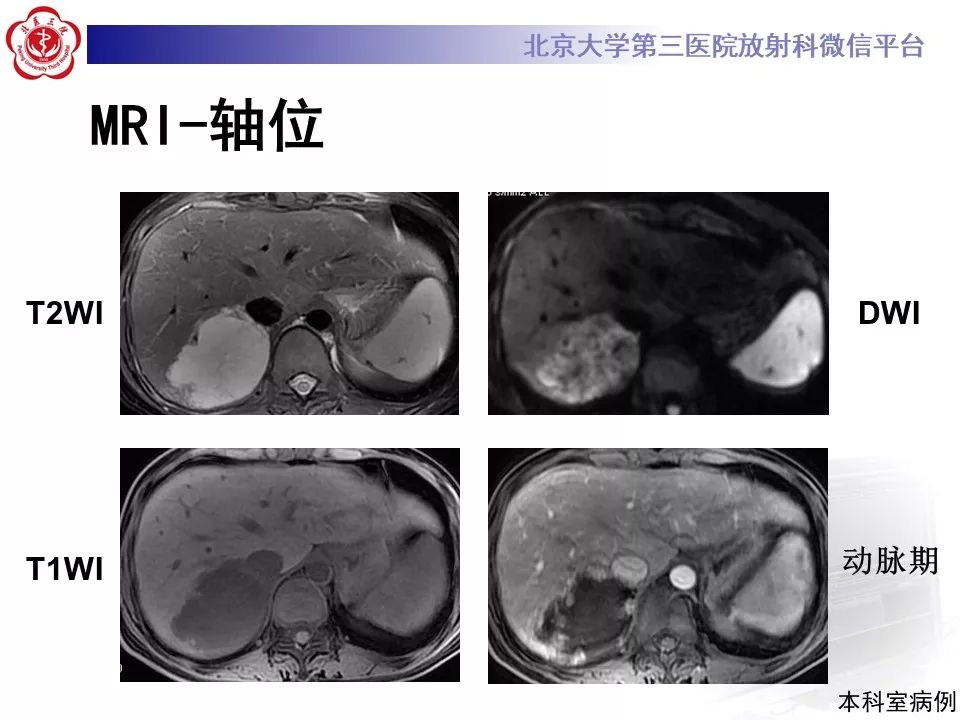 影像PPT - 【PPT】肝胆特异性对比剂的临床应用—肝局灶性病变-29