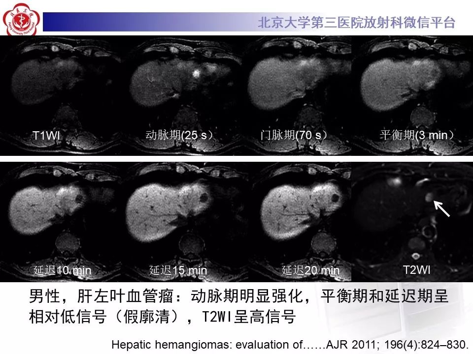 影像PPT - 【PPT】肝胆特异性对比剂的临床应用—肝局灶性病变-38