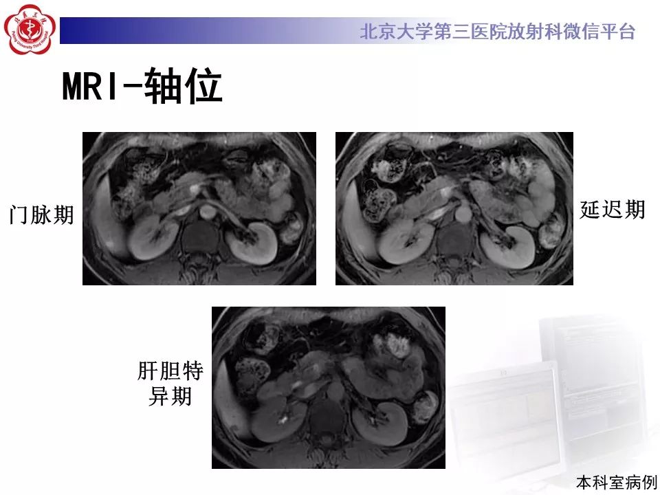 影像PPT - 【PPT】肝胆特异性对比剂的临床应用—肝局灶性病变-35