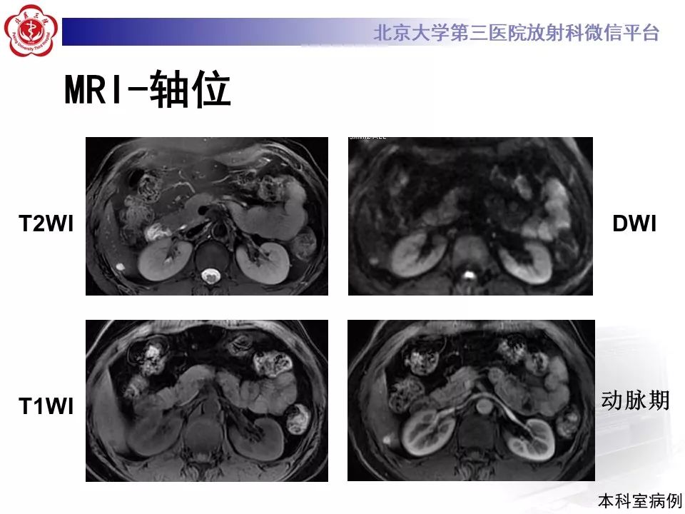 影像PPT - 【PPT】肝胆特异性对比剂的临床应用—肝局灶性病变-34