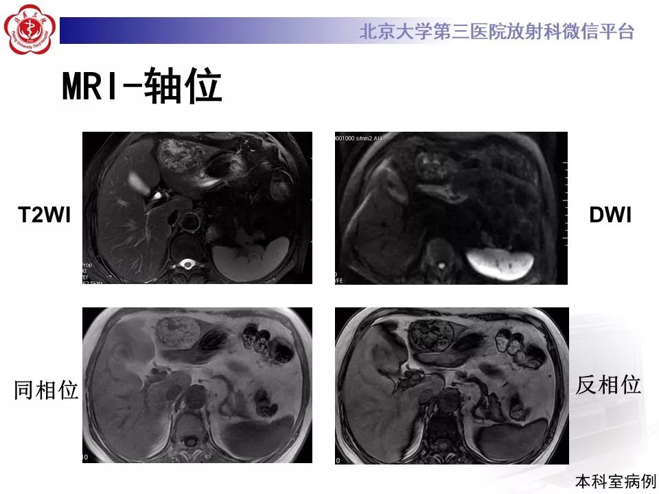 影像PPT - 【PPT】肝胆特异性对比剂的临床应用—肝局灶性病变-41
