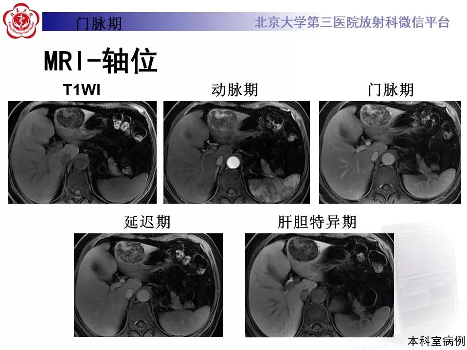 影像PPT - 【PPT】肝胆特异性对比剂的临床应用—肝局灶性病变-42