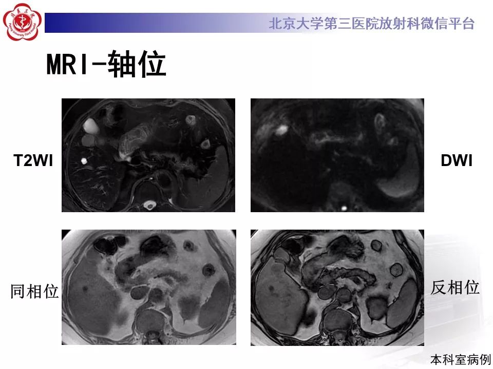 影像PPT - 【PPT】肝胆特异性对比剂的临床应用—肝局灶性病变-47