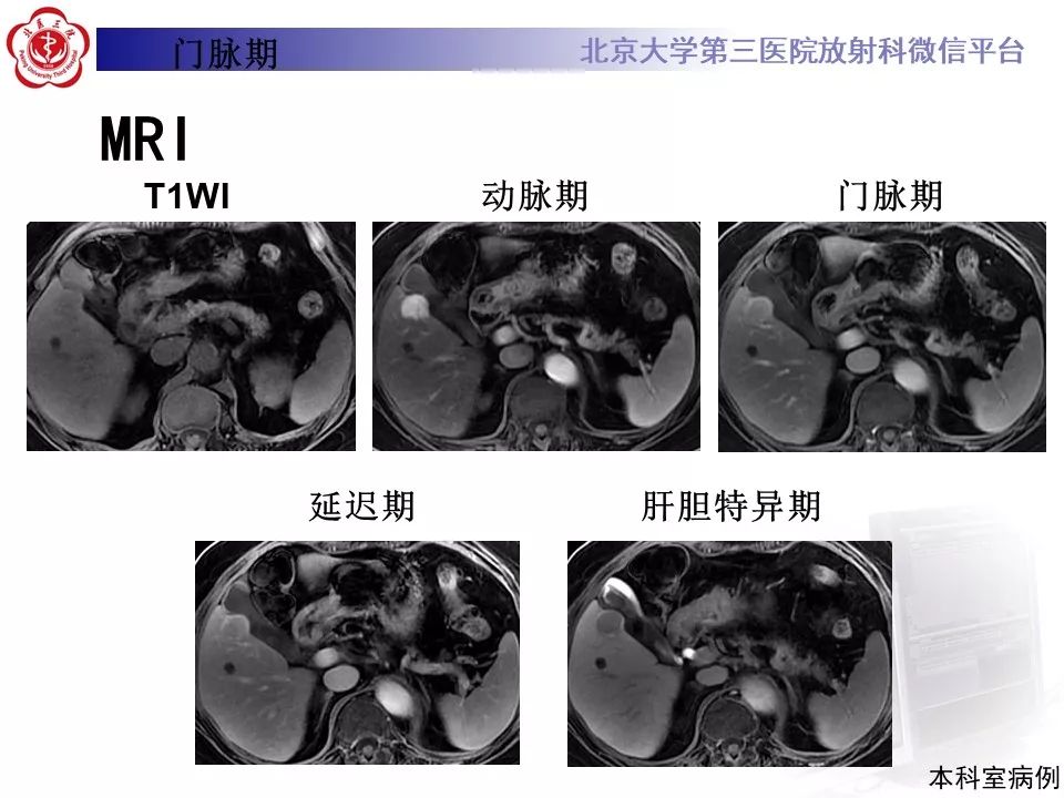 影像PPT - 【PPT】肝胆特异性对比剂的临床应用—肝局灶性病变-48