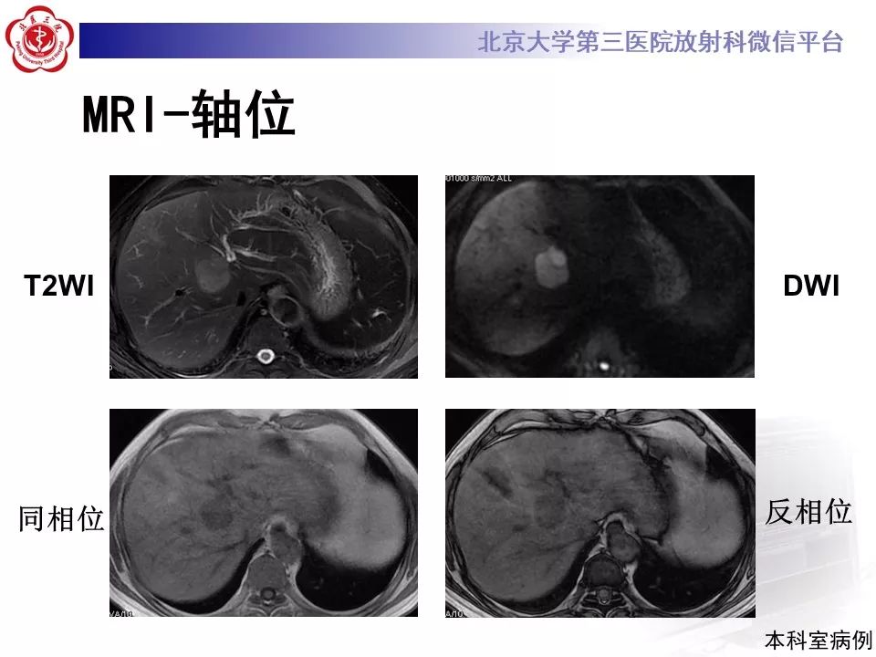 影像PPT - 【PPT】肝胆特异性对比剂的临床应用—肝局灶性病变-54