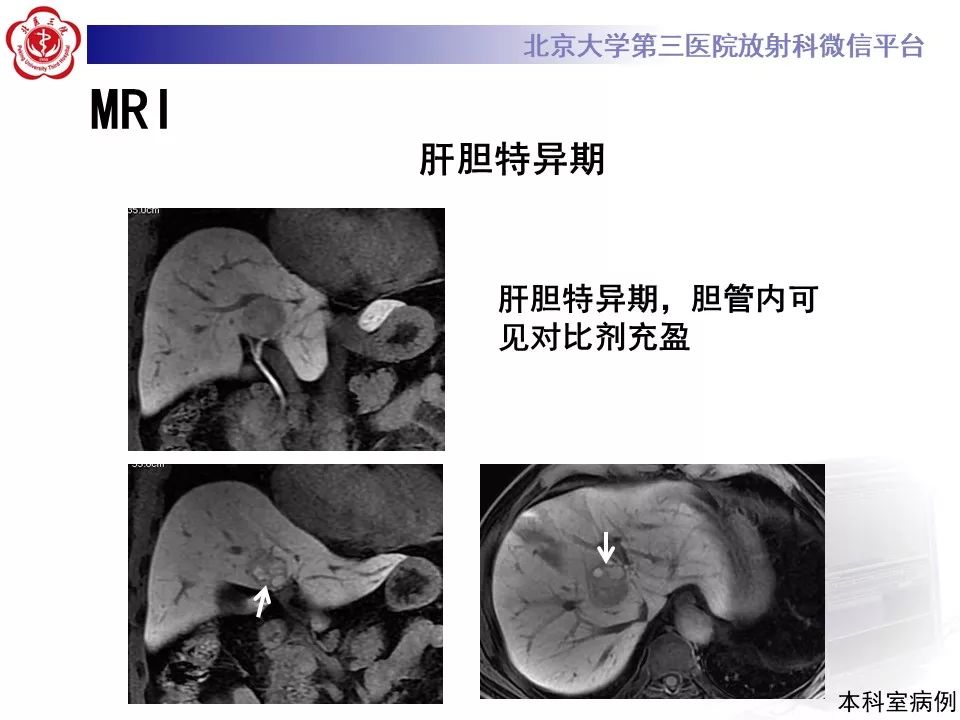 影像PPT - 【PPT】肝胆特异性对比剂的临床应用—肝局灶性病变-56