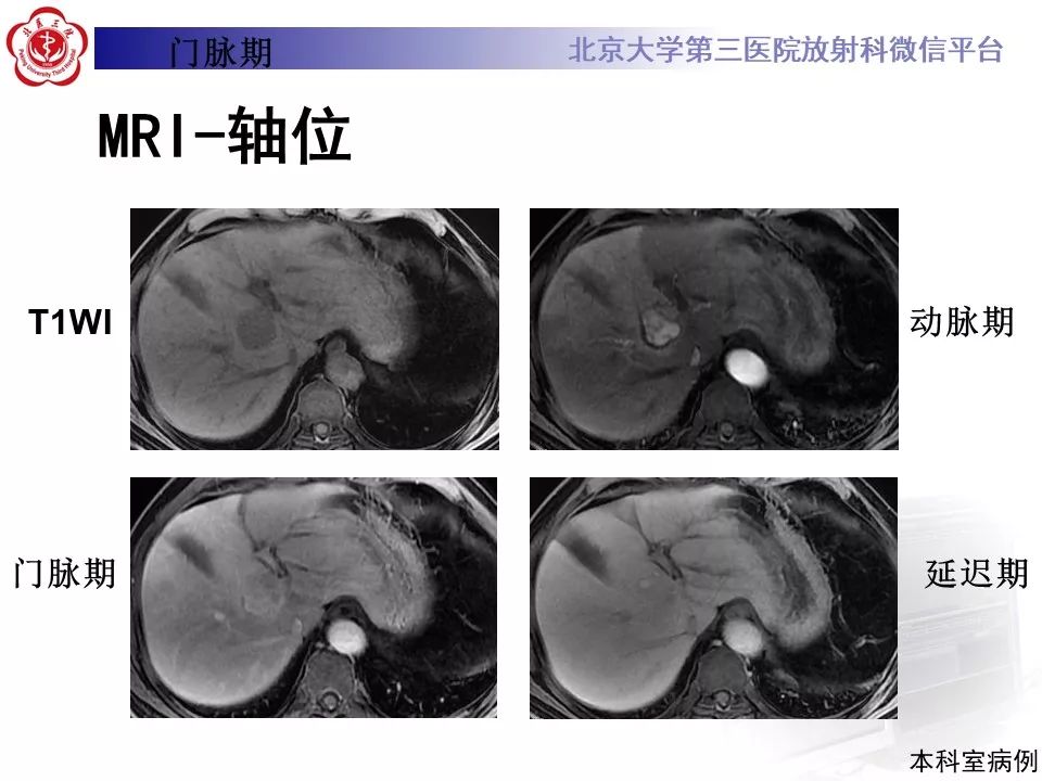 影像PPT - 【PPT】肝胆特异性对比剂的临床应用—肝局灶性病变-55