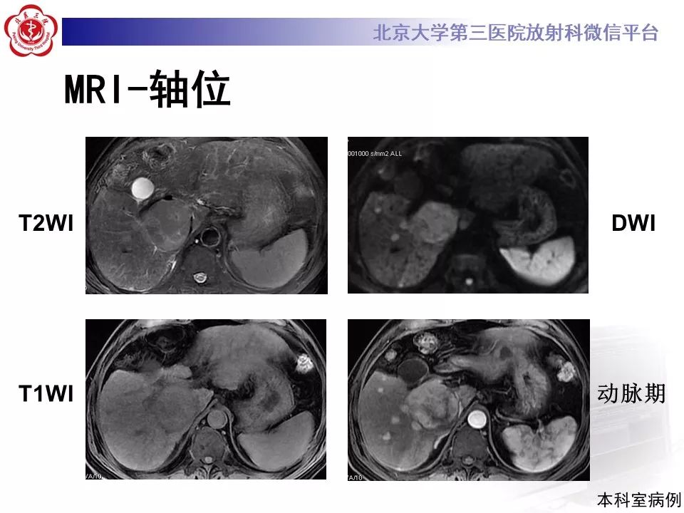 影像PPT - 【PPT】肝胆特异性对比剂的临床应用—肝局灶性病变-61