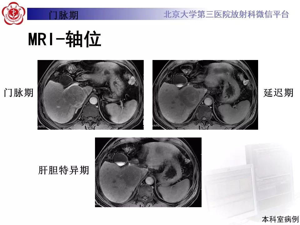 影像PPT - 【PPT】肝胆特异性对比剂的临床应用—肝局灶性病变-62