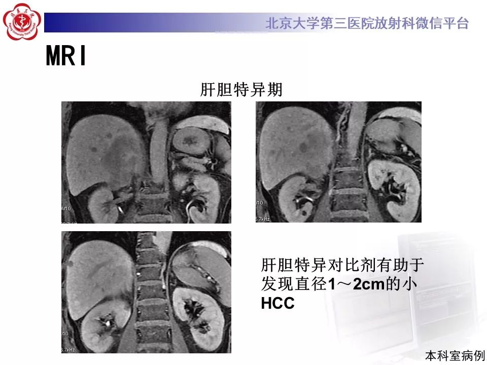 影像PPT - 【PPT】肝胆特异性对比剂的临床应用—肝局灶性病变-63