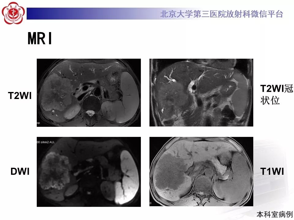 影像PPT - 【PPT】肝胆特异性对比剂的临床应用—肝局灶性病变-67