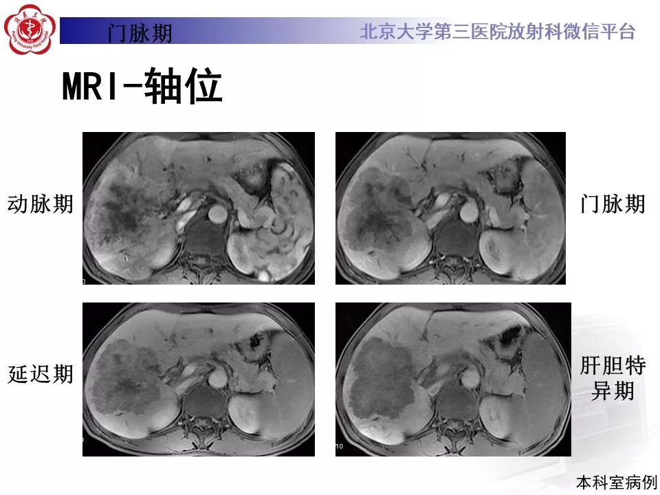 影像PPT - 【PPT】肝胆特异性对比剂的临床应用—肝局灶性病变-68