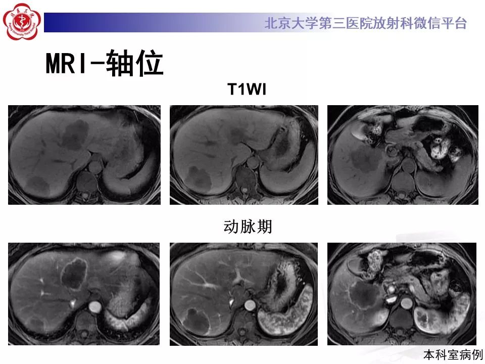 影像PPT - 【PPT】肝胆特异性对比剂的临床应用—肝局灶性病变-75