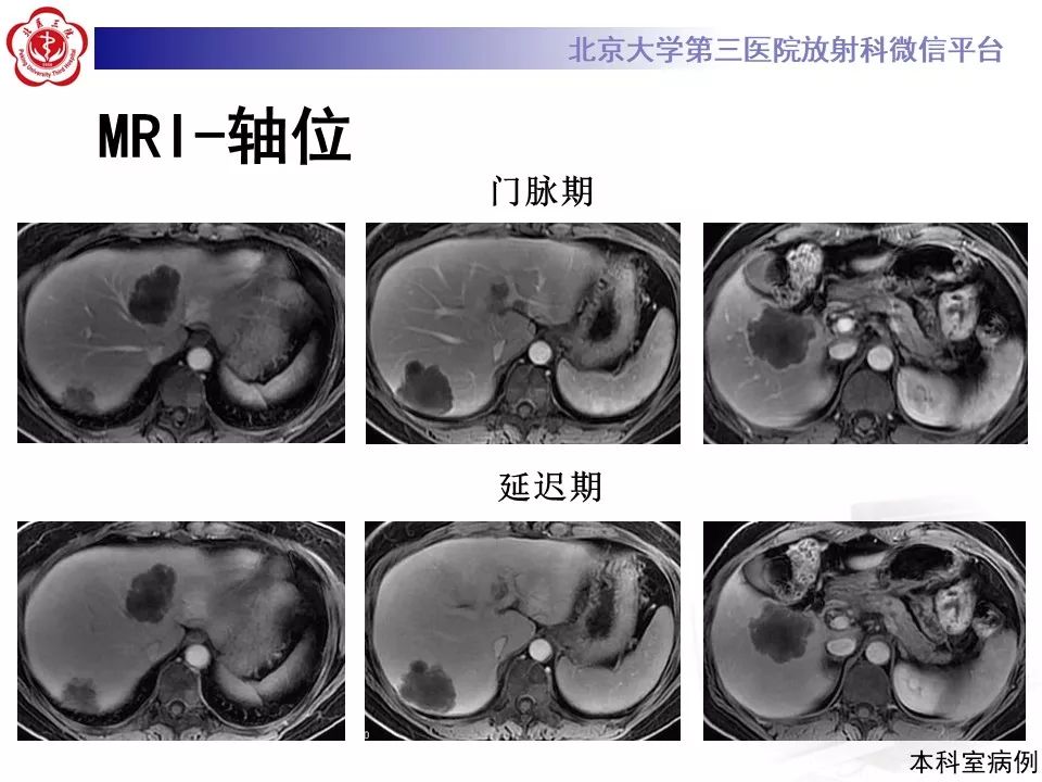 影像PPT - 【PPT】肝胆特异性对比剂的临床应用—肝局灶性病变-76