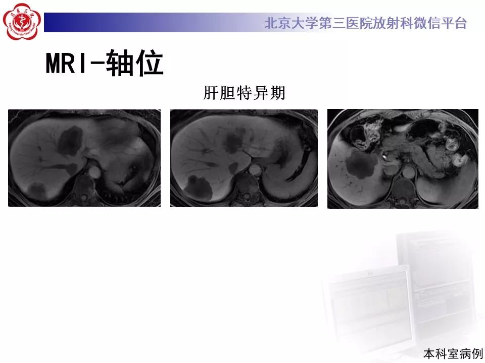 影像PPT - 【PPT】肝胆特异性对比剂的临床应用—肝局灶性病变-77