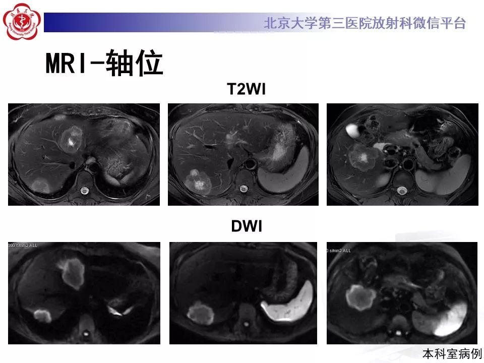 影像PPT - 【PPT】肝胆特异性对比剂的临床应用—肝局灶性病变-74