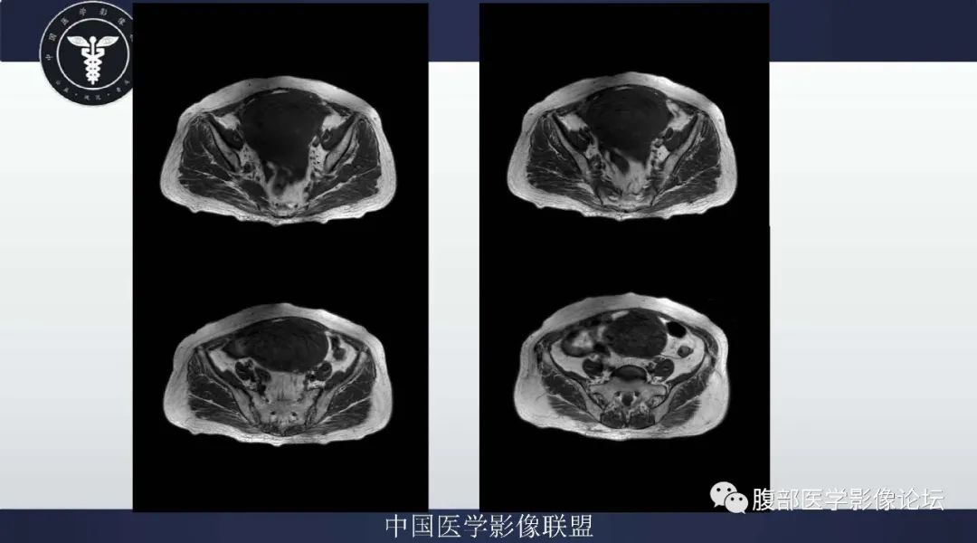 影像PPT - 【病例】卵巢卵泡膜细胞瘤1例MR-4