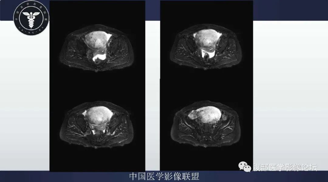 影像PPT - 【病例】卵巢卵泡膜细胞瘤1例MR-5