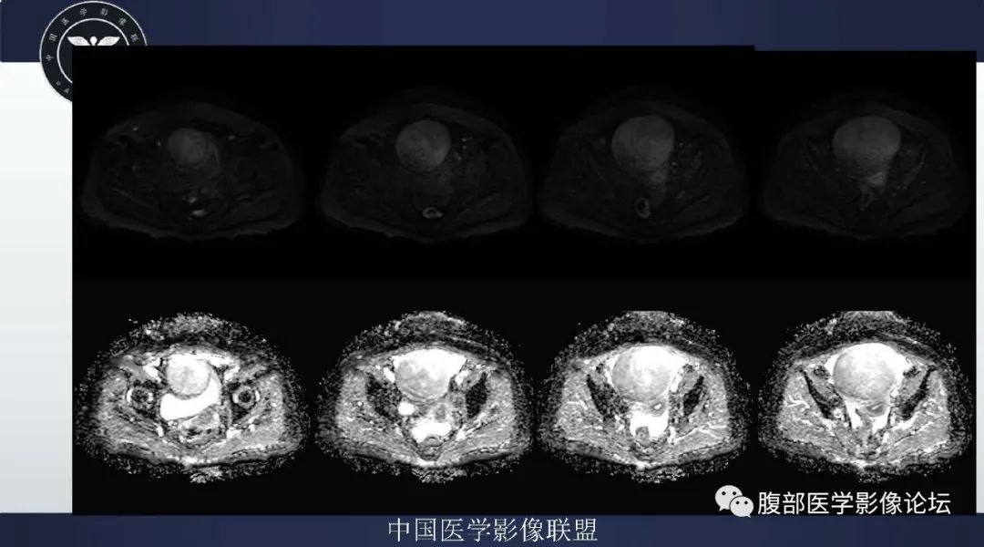 影像PPT - 【病例】卵巢卵泡膜细胞瘤1例MR-6