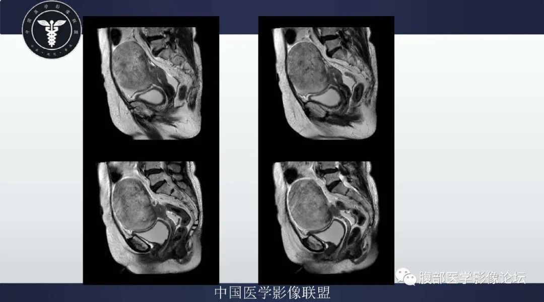 影像PPT - 【病例】卵巢卵泡膜细胞瘤1例MR-3