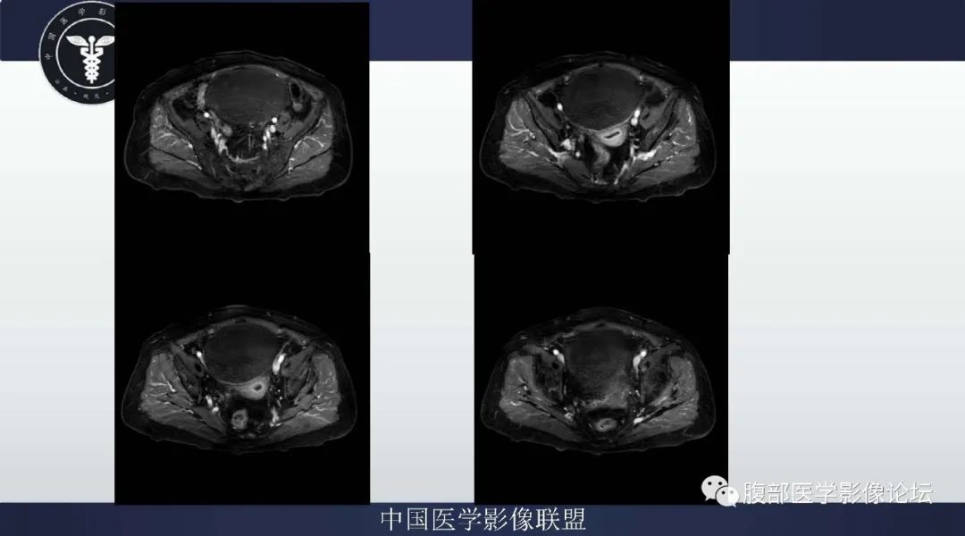 影像PPT - 【病例】卵巢卵泡膜细胞瘤1例MR-7