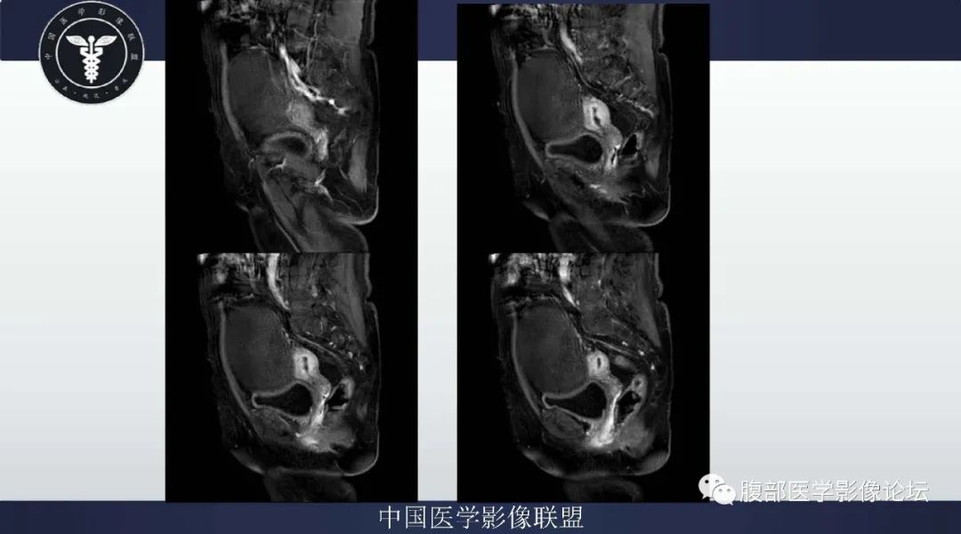 影像PPT - 【病例】卵巢卵泡膜细胞瘤1例MR-8