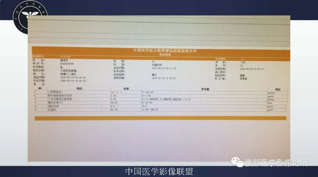 影像PPT - 【病例】卵巢卵泡膜细胞瘤1例MR-11