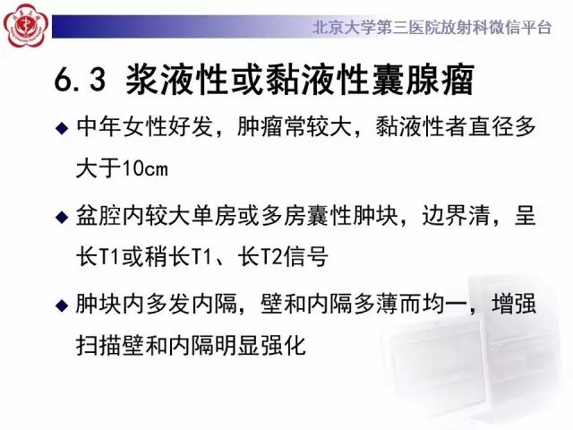 影像PPT - 【病例】卵巢卵泡膜细胞瘤1例MR-21
