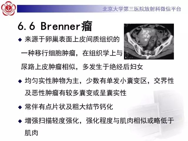 影像PPT - 【病例】卵巢卵泡膜细胞瘤1例MR-24