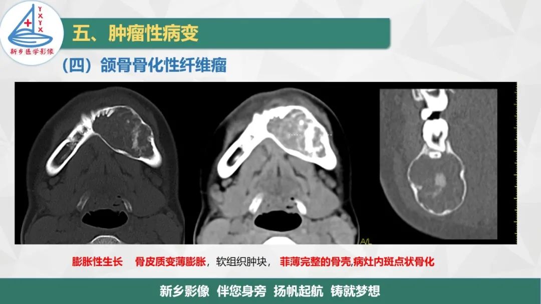 影像PPT - 【PPT】医学影像诊断学教材解读—口腔颌面部疾病2-13