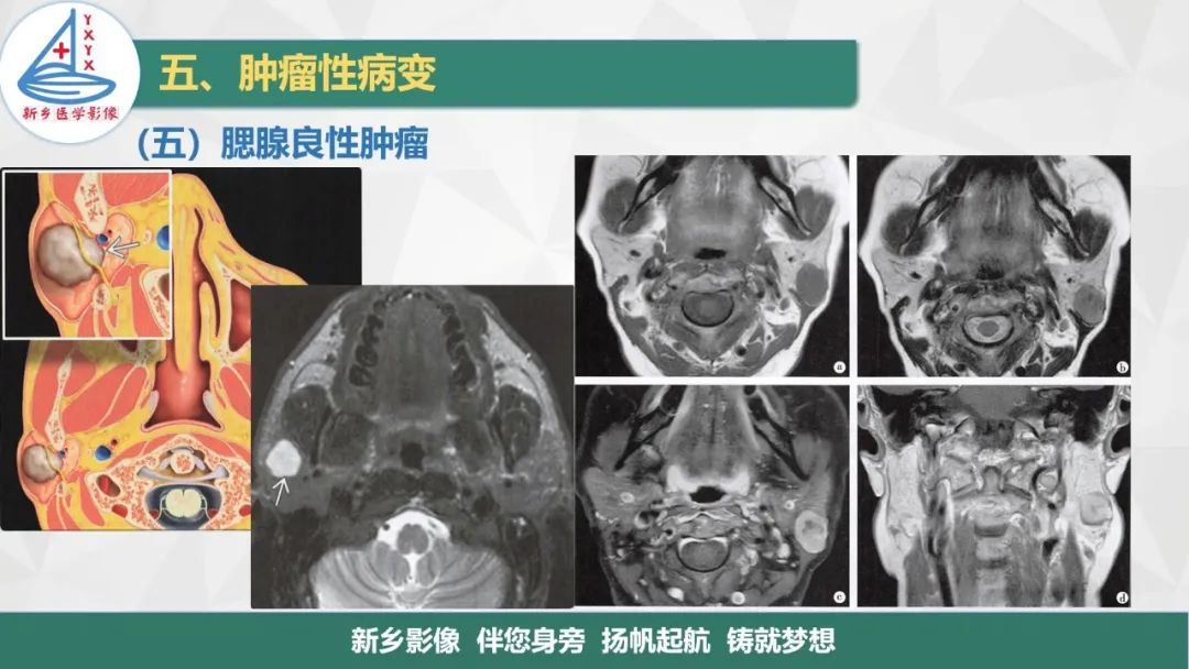 影像PPT - 【PPT】医学影像诊断学教材解读—口腔颌面部疾病2-17